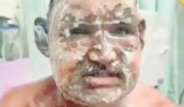 बहू ने ससुर पर पेट्रोल डालकर लगाई आग